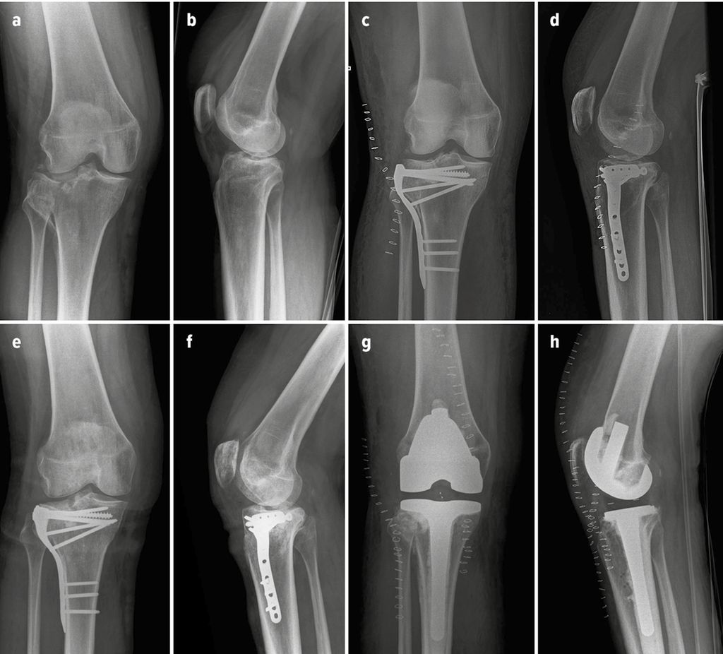 Primäre versus sekundäre Frakturendoprothetik am Kniegelenk Orthopädie & Traumatologie
